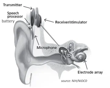 Parts of the cochlear implant.