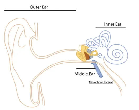 Diagram of implantable microphone